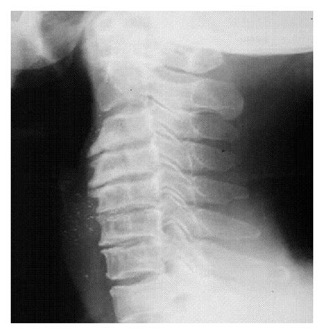 cervical spondylosis compression test|x ray for cervical spondylosis.